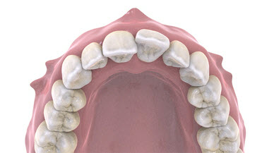 Incorrect inclination of the tooth