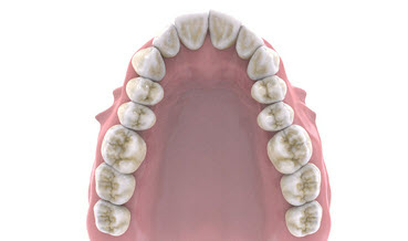 Expansion of dental arches in the area of ​​premolars