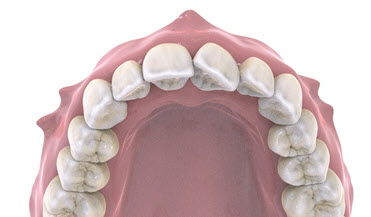 Rotated tooth